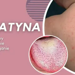 Szkarlatyna: czerwona wysypka na skórze i nalot na języku, objawy podobne do rumienia zakaźnego.