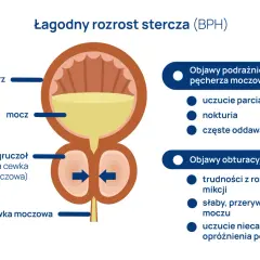 Ilustracja przedstawia łagodny rozrost prostaty (BPH), powiększony gruczoł uciskający cewkę moczową, powodując objawy podrażnienia i obturacji.