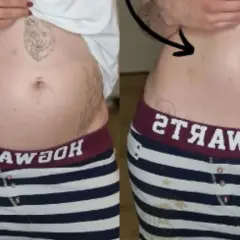 Porównanie brzucha: po lewej widoczne wzdęcia, po prawej płaski. Endometrioza jak wygląda? Czasem tak.