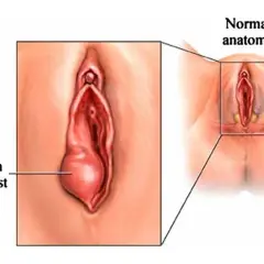 Ilustracja pokazuje zapalenie gruczołu Bartholina, uwidaczniając powiększoną torbiel w porównaniu do prawidłowej anatomii.