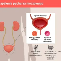 Ilustracja przedstawia budowę układu moczowego i objawy zapalenia pęcherza. Widać pęcherz moczowy, nerki i objawy takie jak ból, pieczenie, nietrzymanie moczu.