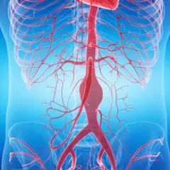 Widok anatomiczny naczyń krwionośnych, z widocznym poszerzeniem w obrębie aorty brzusznej.