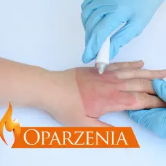 Ręka z oparzeniem, na które nakładany jest krem. Widoczna czerwona rana.