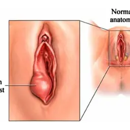 Ilustracja pokazuje zapalenie gruczołu Bartholina, uwidaczniając powiększoną torbiel w porównaniu do prawidłowej anatomii.