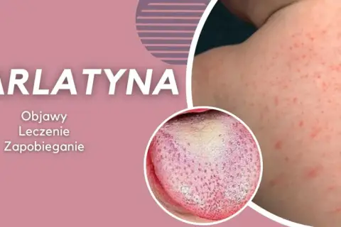 Szkarlatyna: czerwona wysypka na skórze i nalot na języku, objawy podobne do rumienia zakaźnego.