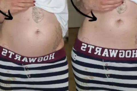 Porównanie brzucha: po lewej widoczne wzdęcia, po prawej płaski. Endometrioza jak wygląda? Czasem tak.