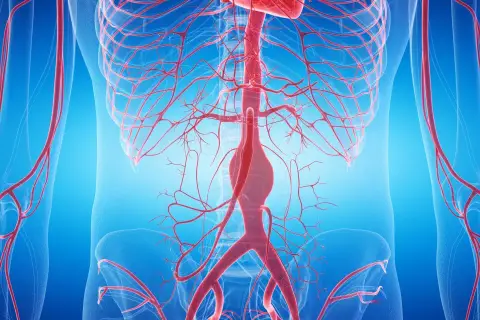 Widok anatomiczny naczyń krwionośnych, z widocznym poszerzeniem w obrębie aorty brzusznej.