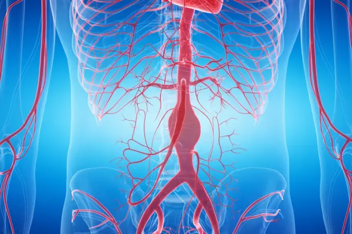 Widok anatomiczny naczyń krwionośnych, z widocznym poszerzeniem w obrębie aorty brzusznej.