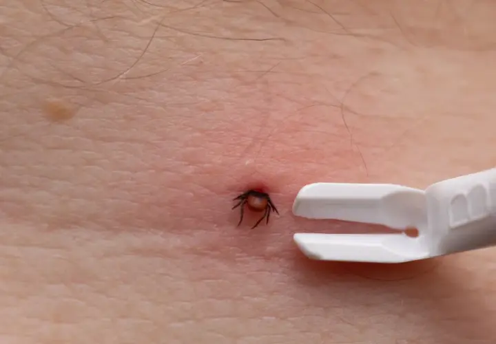 Urwany kleszcz w skórze, tuż obok białego narzędzia do jego usuwania.