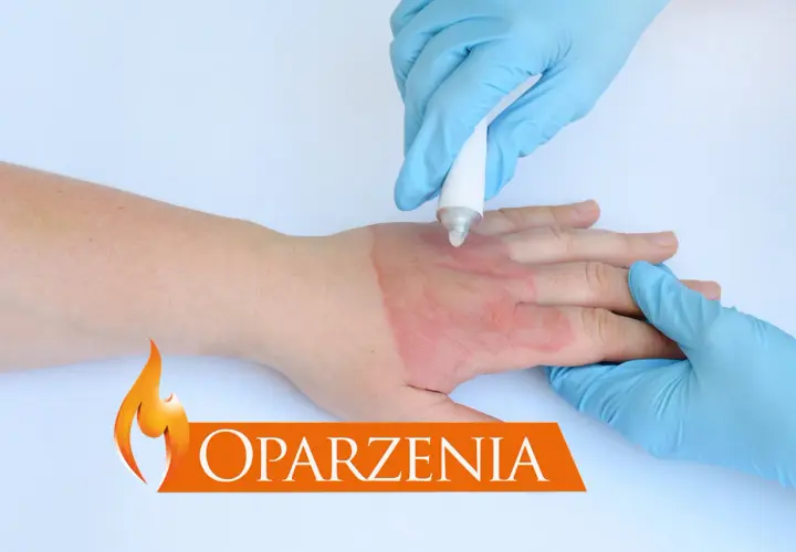 Ręka z oparzeniem, na które nakładany jest krem. Widoczna czerwona rana.
