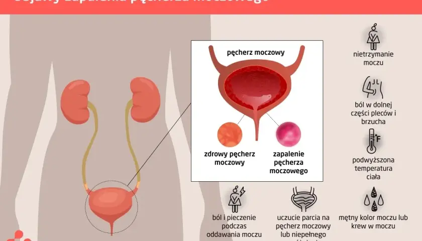 Ilustracja przedstawia objawy zapalenia pęcherza moczowego: ból, pieczenie, nietrzymanie moczu, ból pleców, gorączkę, mętny mocz.