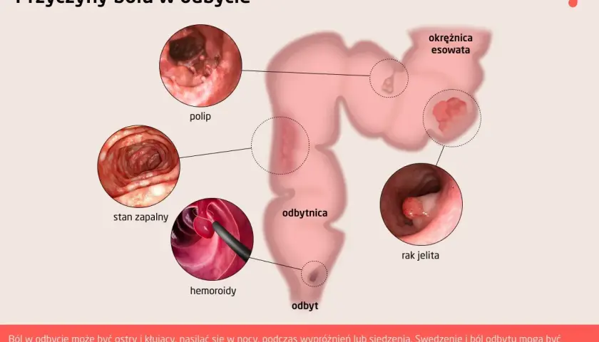 Ilustracja przedstawia przyczyny bólu w odbycie: polipy, stan zapalny, hemoroidy, raka jelita, okrężnicę esowatą.