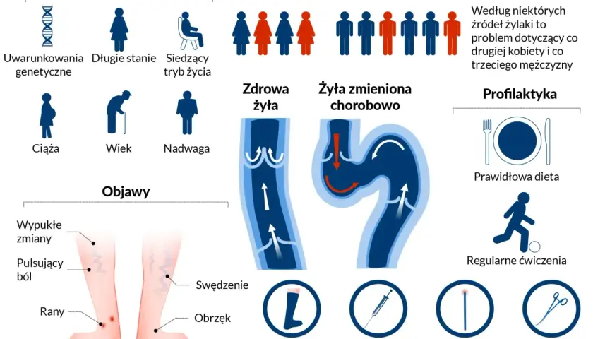 Widoczne nogi z widocznymi pajęczynami naczyniowymi. Lupa powiększa fragment skóry, uwidaczniając żylaki.