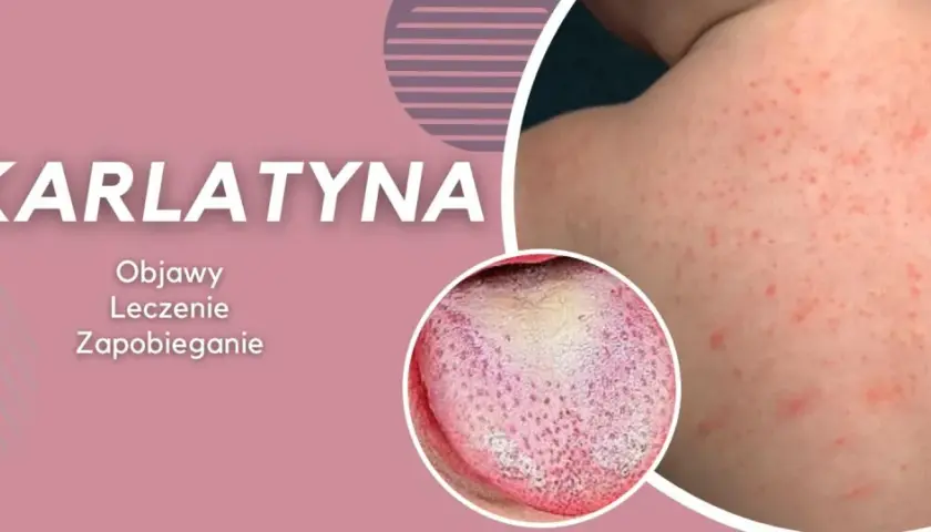Szkarlatyna: czerwona wysypka na skórze i nalot na języku, objawy podobne do rumienia zakaźnego.