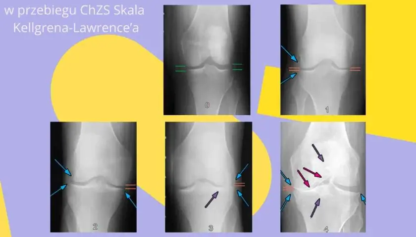 Choroba zwyrodnieniowa: Czy Cartexan to rozwiązanie dla Twoich stawów?