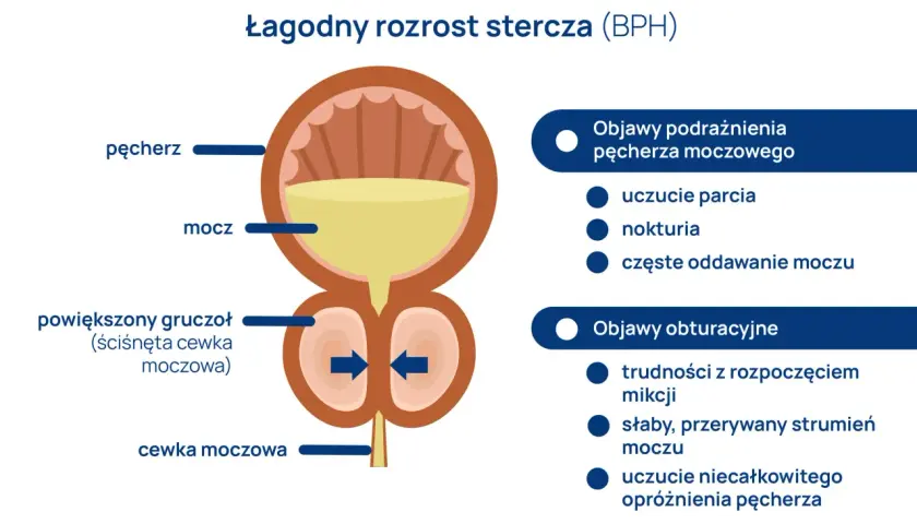 Ilustracja przedstawia łagodny rozrost prostaty (BPH), powiększony gruczoł uciskający cewkę moczową, powodując objawy podrażnienia i obturacji.