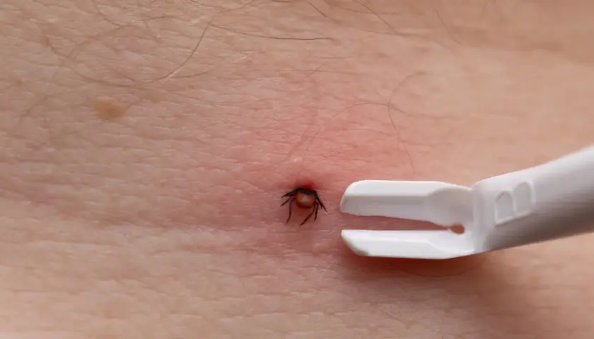 Urwany kleszcz w skórze, tuż obok białego narzędzia do jego usuwania.