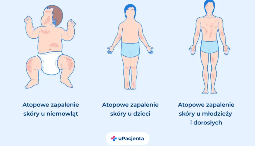 Ilustracja pokazuje atopowe zapalenie skóry u niemowląt, dzieci i dorosłych, uwidaczniając typowe objawy na skórze w różnych grupach wiekowych.