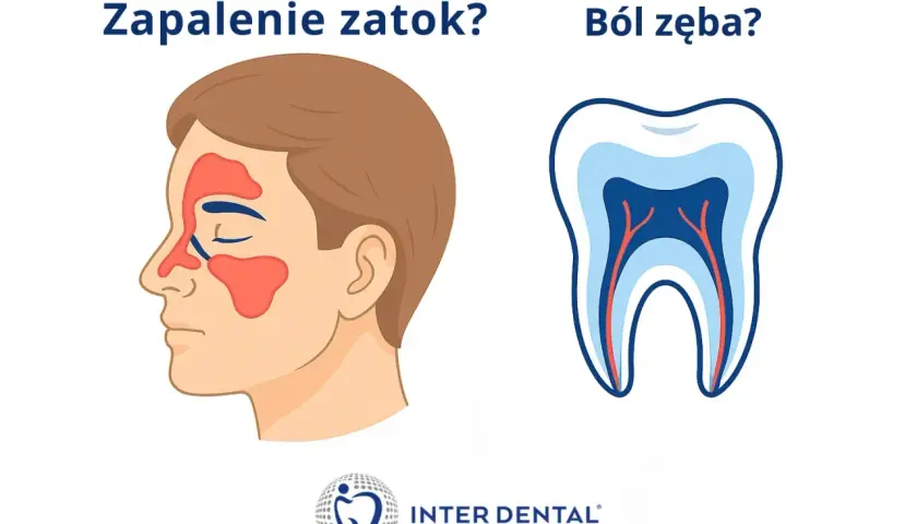 Zapalenie zatok czy ból zęba? Ilustracja przedstawia profil twarzy z zaznaczonymi zatokami oraz przekrój zęba.