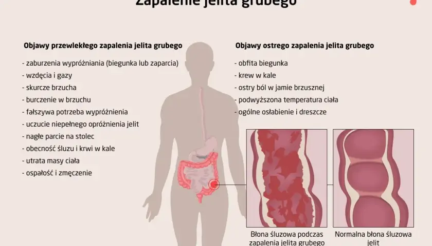 Ilustracja przedstawia objawy zapalenia jelita grubego: przewlekłe i ostre. Wymienione symptomy to m.in. biegunka, krew w kale, ból brzucha, gorączka.