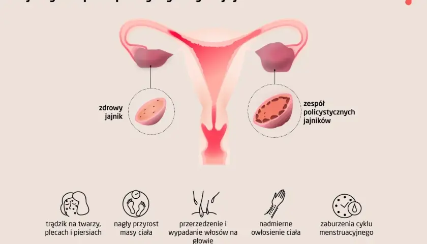 Ilustracja porównuje zdrowy jajnik z jajnikiem w zespole policystycznych jajników, pokazując objawy takie jak trądzik, przyrost masy ciała i zaburzenia cyklu.