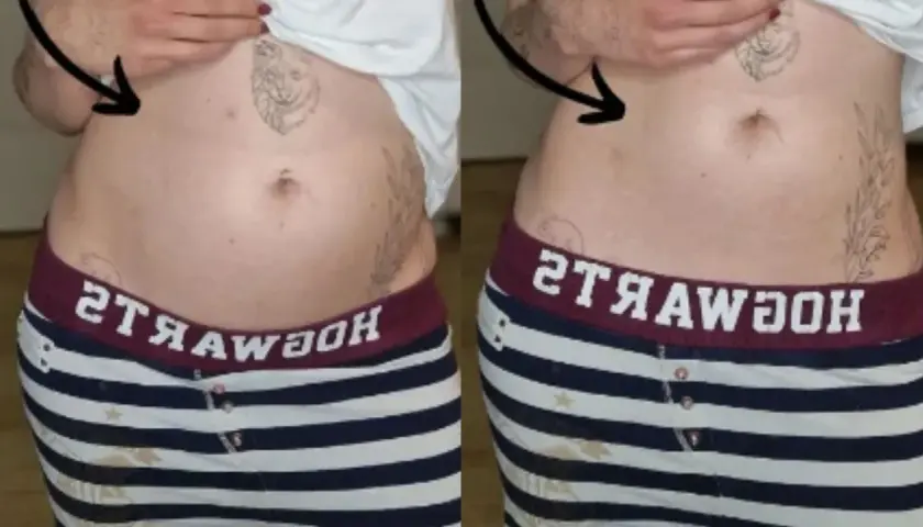 Porównanie brzucha: po lewej widoczne wzdęcia, po prawej płaski. Endometrioza jak wygląda? Czasem tak.