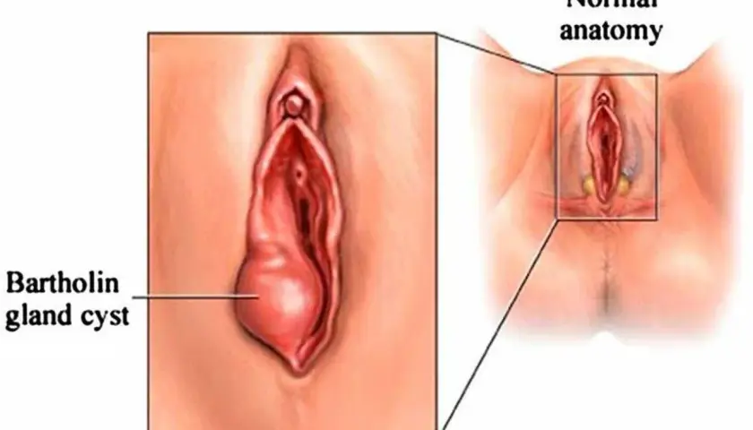Ilustracja pokazuje zapalenie gruczołu Bartholina, uwidaczniając powiększoną torbiel w porównaniu do prawidłowej anatomii.