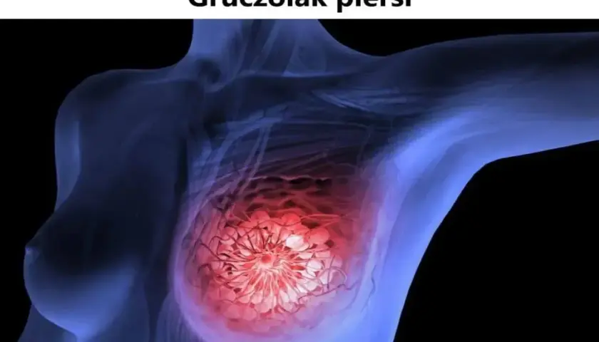 Schemat piersi z zaznaczonym gruczolakiem.