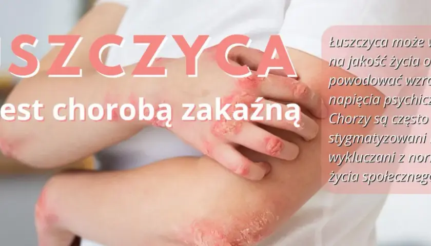 Łuszczyca na łokciach i dłoniach. Choroba nie jest zakaźna, ale wpływa na jakość życia i może prowadzić do napięcia psychicznego.
