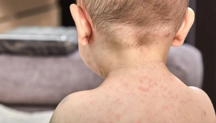 Skóra dziecka pokryta drobnymi, czerwonymi wykwitami, które mogą być objawem trzydniówki.