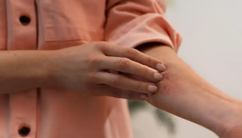 Dłoń dotyka przedramienia z zaczerwienionymi, swędzącymi zmianami skórnymi, które mogą być objawem miopatii.