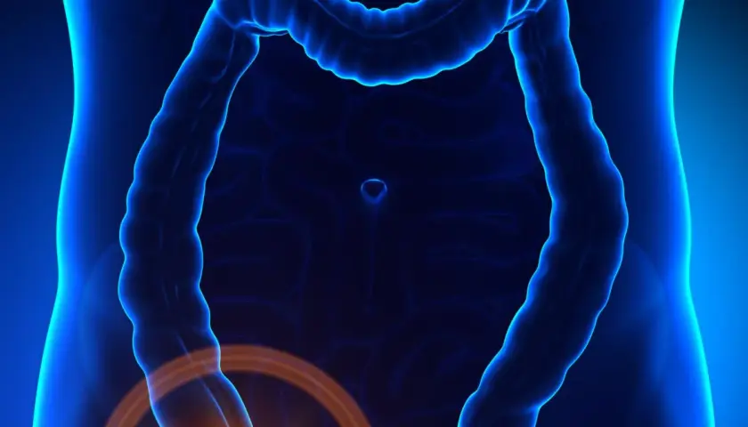 Anatomical illustration showing the intestines with a highlighted area indicating potential zapalenie wyrostka robaczkowego.