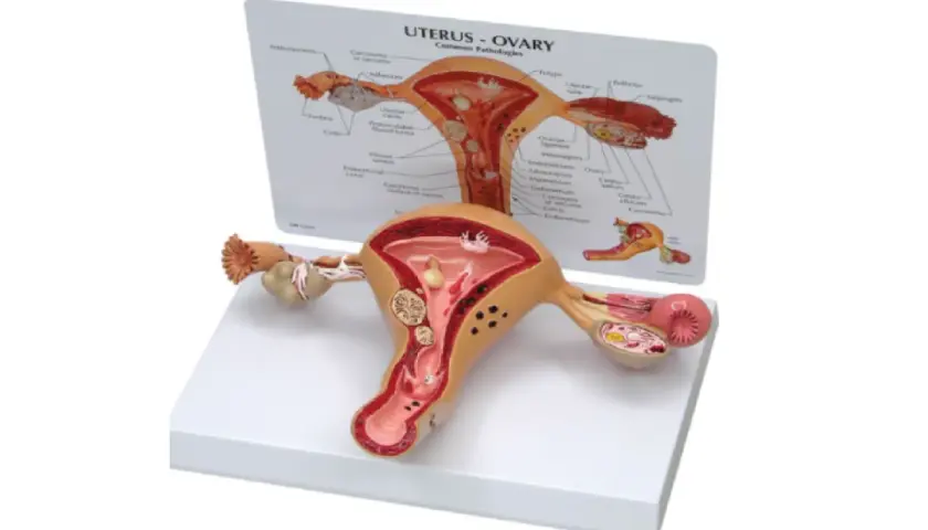 Model anatomiczny narządu rodnego kobiety z widocznymi jajnikami, macicą i jajowodami. Na tablicy informacyjnej zaznaczono patologie.