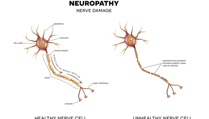 Ilustracja porównuje zdrową i uszkodzoną komórkę nerwową, wyjaśniając, co to jest neuropatia – uszkodzenie nerwów prowadzące do utraty czucia.