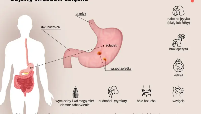 Ilustracja przedstawia objawy wrzodów żołądka: nalot na języku, brak apetytu, zgaga, bóle brzucha, wzdęcia, wymioty.