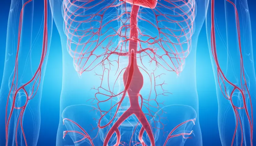 Widok anatomiczny naczyń krwionośnych, z widocznym poszerzeniem w obrębie aorty brzusznej.