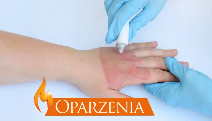 Ręka z oparzeniem, na które nakładany jest krem. Widoczna czerwona rana.