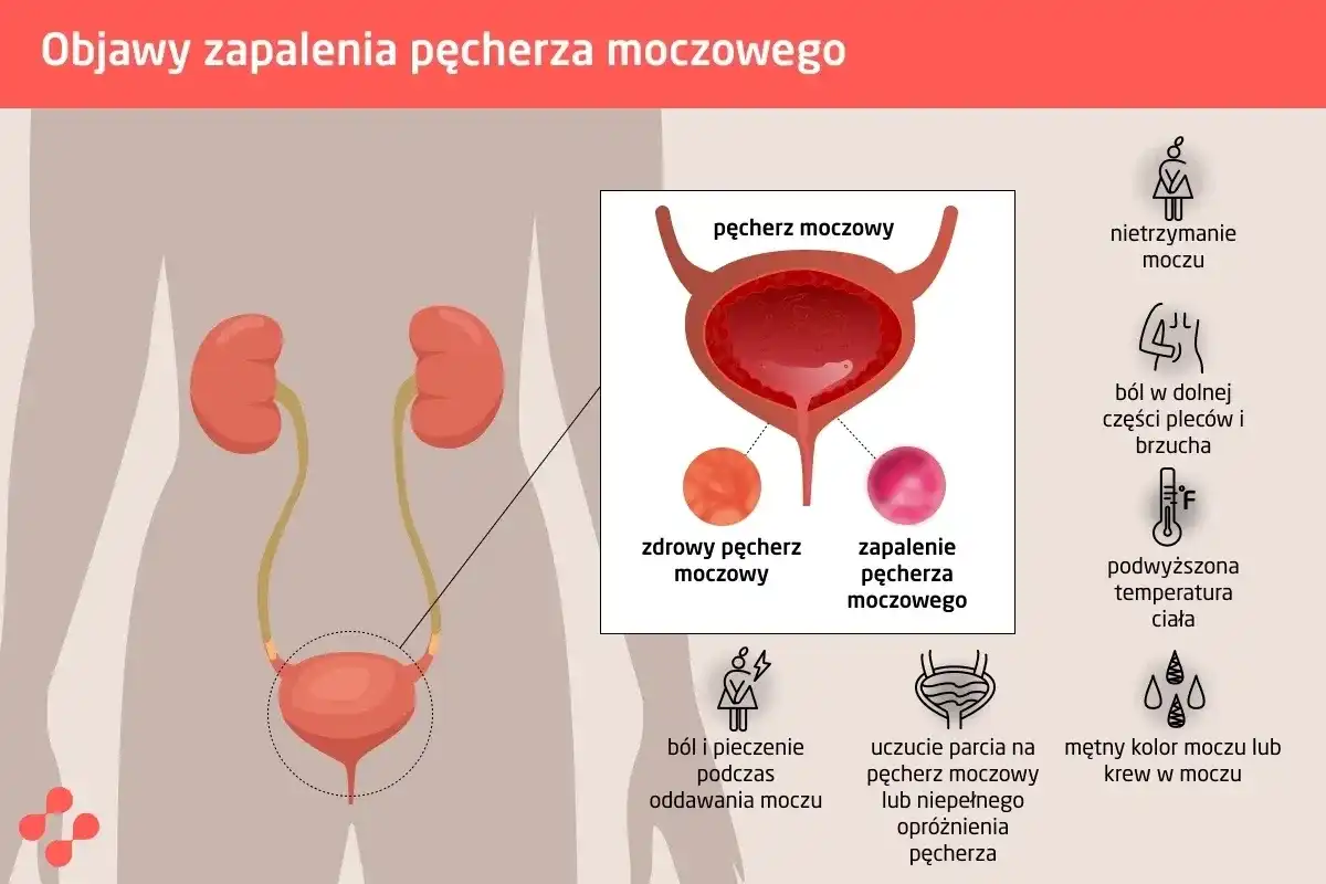 Pęcherz moczowy - objawy, budowa, profilaktyka. Czy znasz swój?