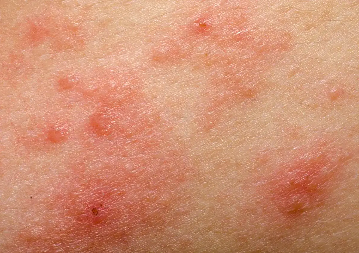 Skóra z zaczerwienieniem i opuchlizną po ukąszeniu owada. Zdjęcia pokazują reakcję alergiczną.