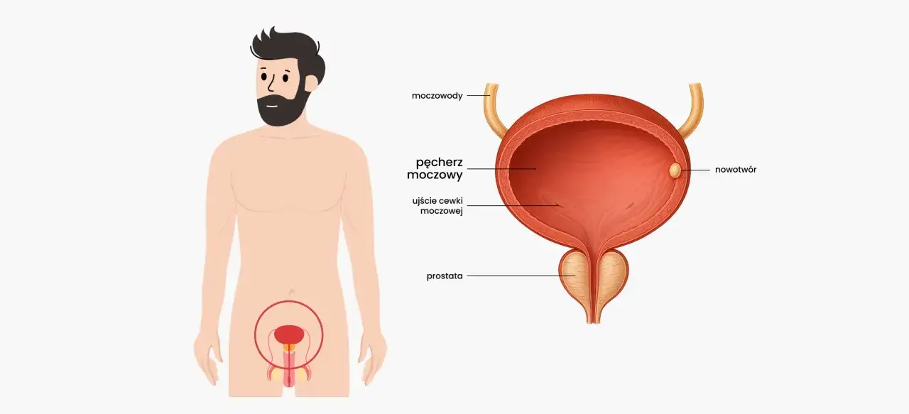 Anatomia męskiego układu moczowego z zaznaczonym pęcherzem, prostatą i nowotworem w pęcherzu.