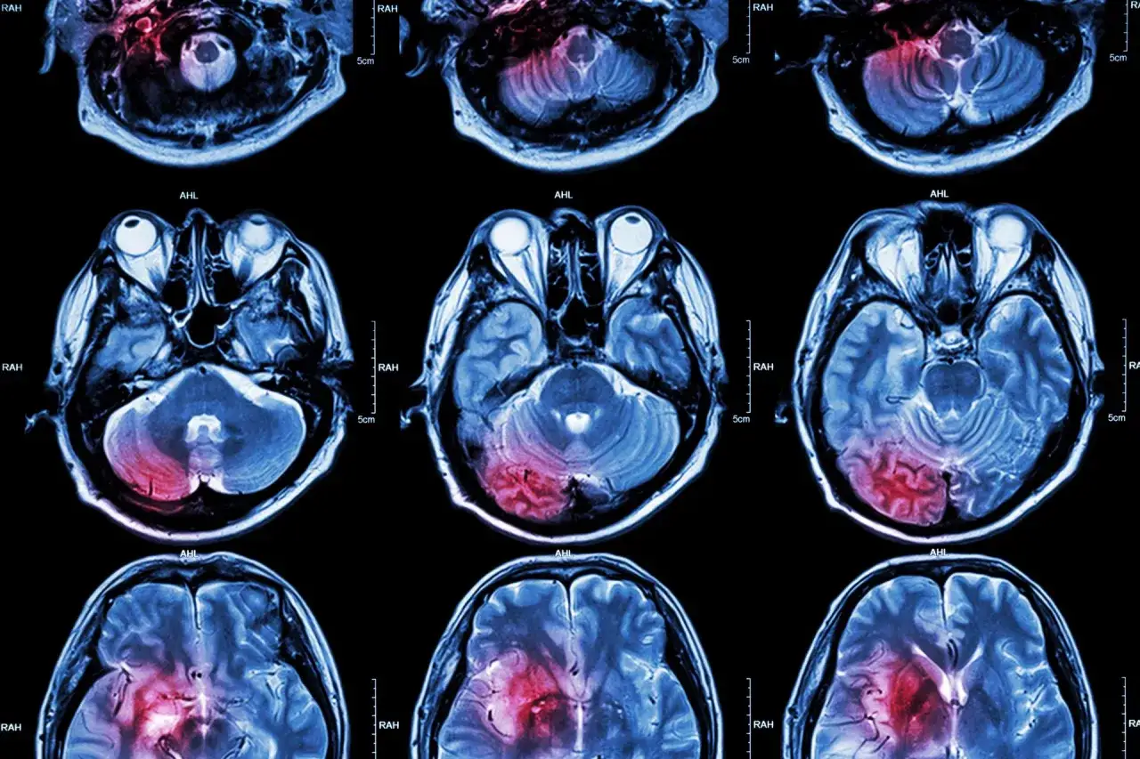 Przekroje mózgu MRI pokazują obszary uszkodzeń, które mogą być objawami mikroudaru.