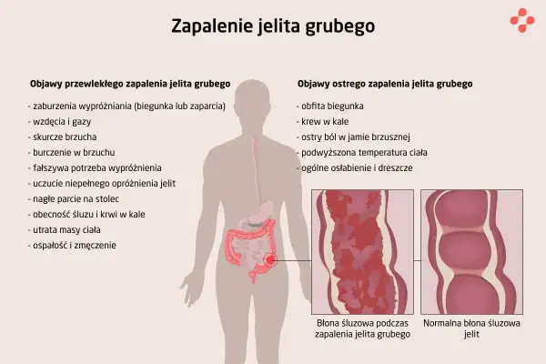 Ilustracja przedstawia objawy zapalenia jelita grubego, w tym bóle brzucha, biegunkę i krew w kale. Pokazuje też porównanie błony śluzowej jelita grubego podczas zapalenia i w stanie normalnym.
