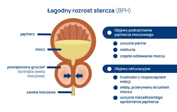 Ilustracja przedstawia łagodny rozrost prostaty (BPH), powiększony gruczoł uciskający cewkę moczową, powodując objawy podrażnienia i obturacji.