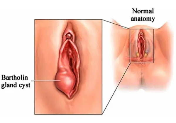 Ilustracja pokazuje zapalenie gruczołu Bartholina, uwidaczniając powiększoną torbiel w porównaniu do prawidłowej anatomii.