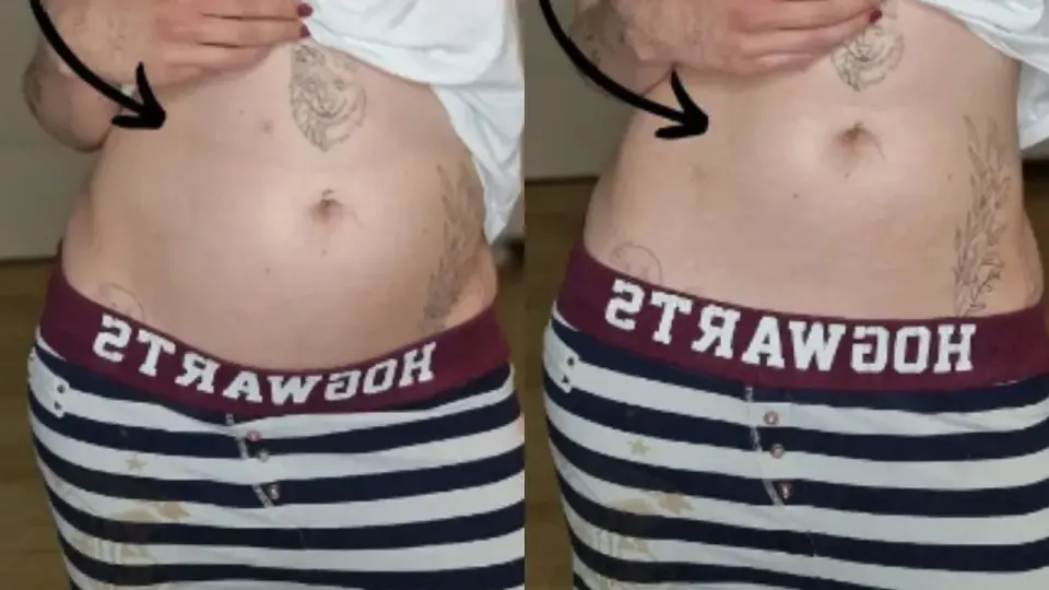 Brzuch przy endometriozie - jak go rozpoznać i odróżnić od wzdęcia